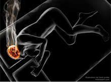 Epilessia: sintomi e trattamenti